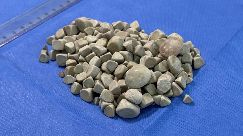 GENÇ KIZIN VÜCUDUNDAN 287 TAŞ ÇIKARILDI: TÜRKİYE'DE NADİR GÖRÜLEN VAKA!